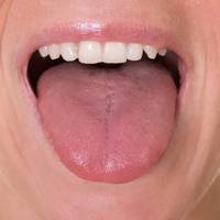 Перші пять ознак раку язика