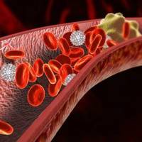 Тромб не почекає: 6 ознак, що в ваших жилах засів смертельно небезпечний згусток крові
