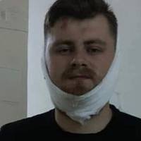 Зламали щелепу за 