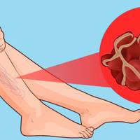 8 продуктів, які розріджують кров і запобігають тромбозу