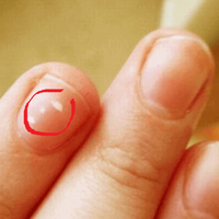 Що означають білі цятки на нігтях?