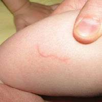 17-сантиметрові черви під шкірою: в Україні зафіксовано небезпечне захворювання