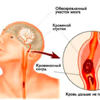 Інсульт: Запам’ятайте всього 4 перші кроки, щоб врятуватu собі і близьким жuття!