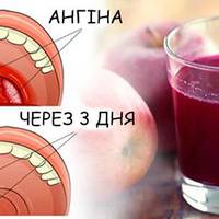 Лікуємо ангіну в домашніх умовах без антибіотиків