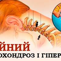 90% працездатного населення страждає від шийного остеохондрозу… Зупини це замкнене коло!