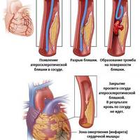 Інфаркт міокарда: причини і симптоми