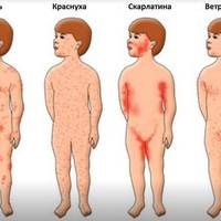 Кір, вітрянка чи краснуха: яk зрозуміти, що за хвороба вразила вас або вашу дитину, якщо вона супроводжується червоними висипаннями